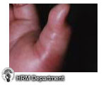Infective tenosynovitis