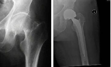 Factures of the Lower Extremity - Hip