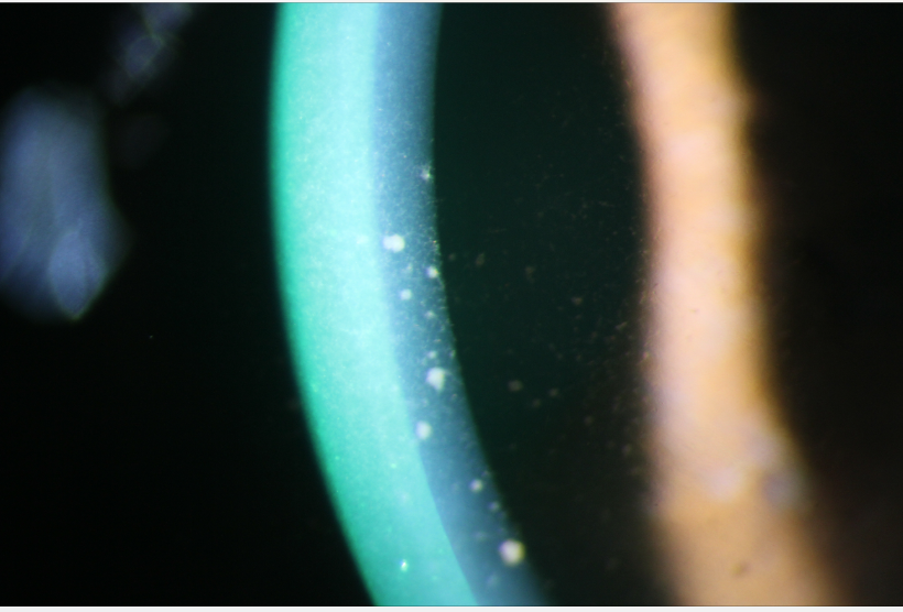 Keratic precipitates