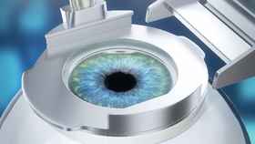 Blade LASIK Procedure - Step 1