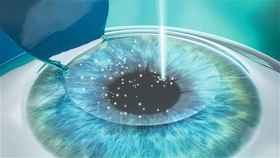 Blade LASIK Procedure - Step 2