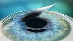 Blade LASIK Procedure - Step 3