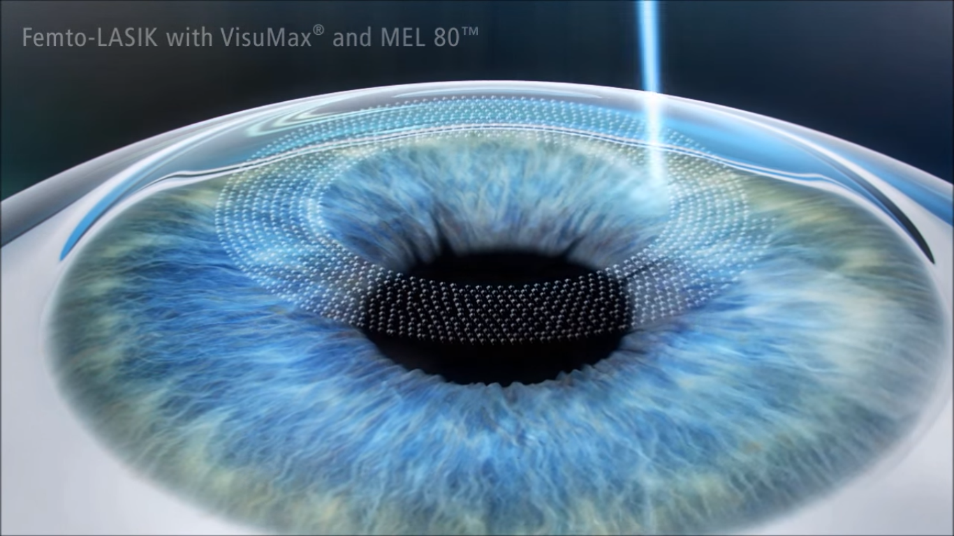 Femto LASIK