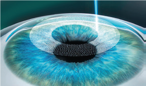 PRESBYOND Procedure - Step 1