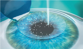 PRESBYOND Procedure - Step 3