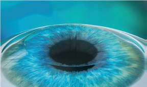 PRESBYOND Procedure - Step 4