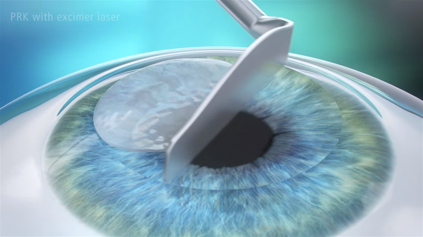 PRK Procedure - Step 1