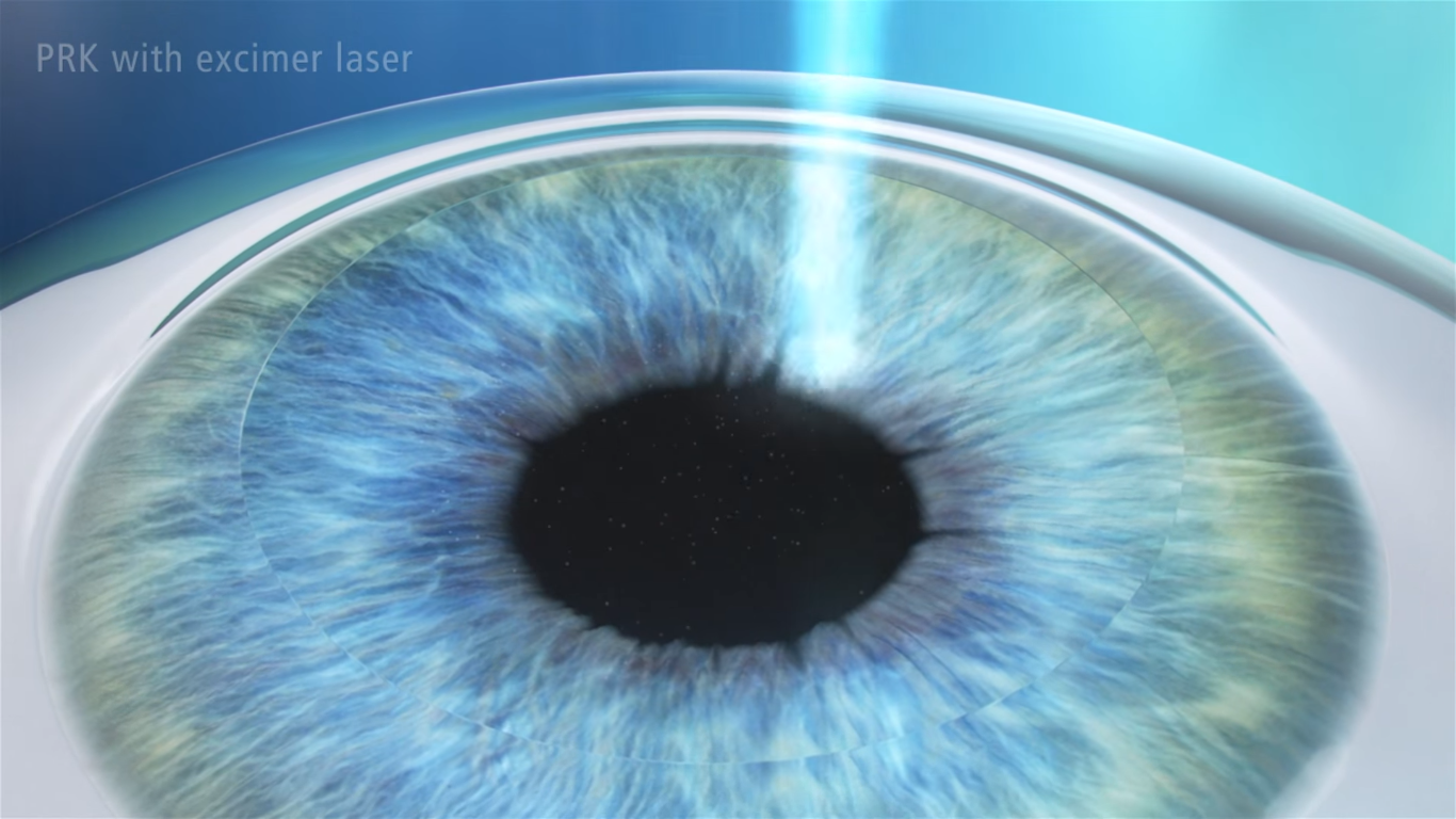 PRK Procedure - Step 2