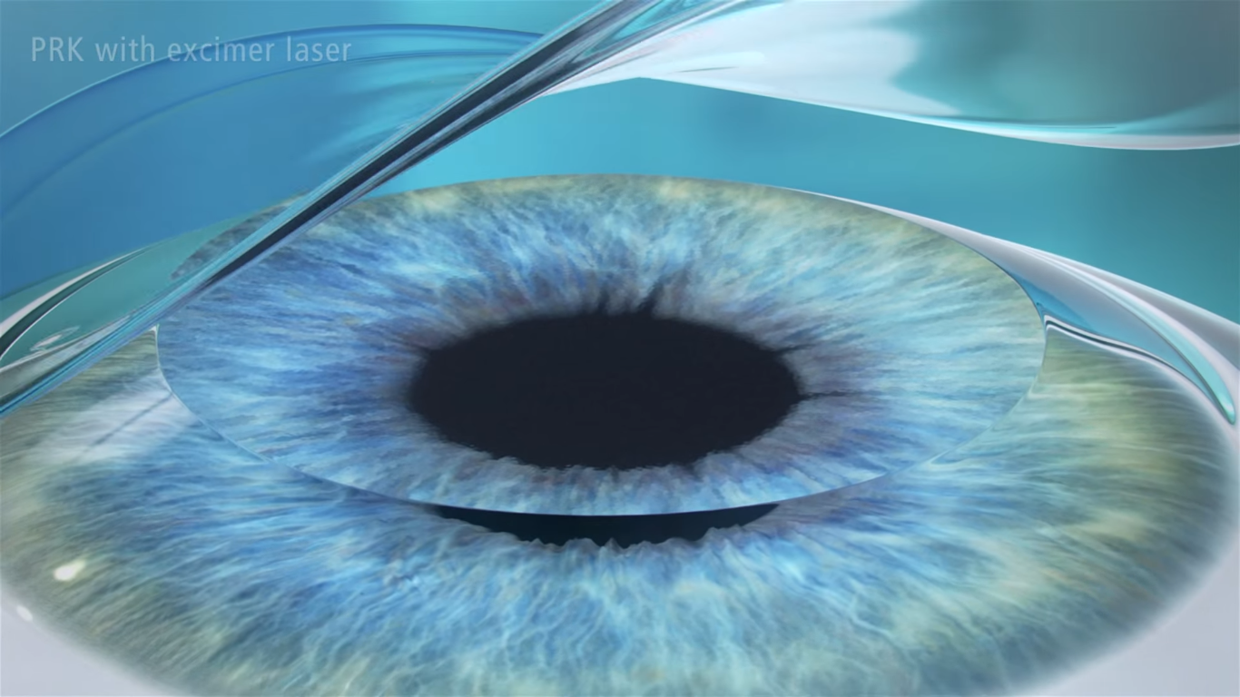 PRK Procedure - Step 3