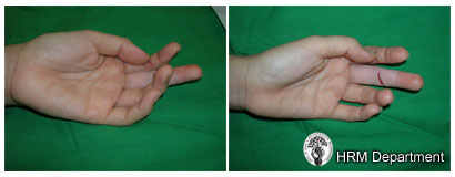 Typical posture of a cut flexor tendon