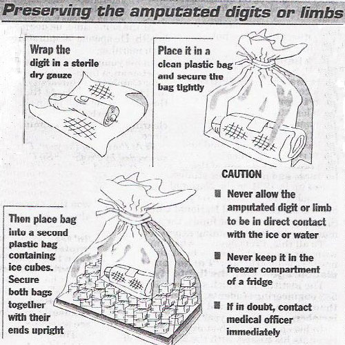 Preserving the amputated digits or limbs