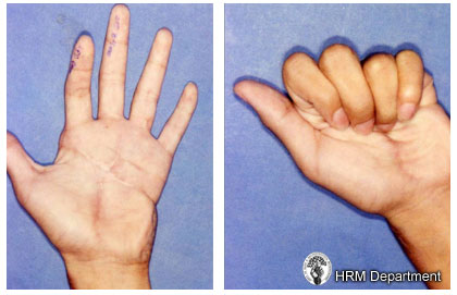 Replantation Surgery